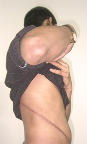 A kidney seller's scar